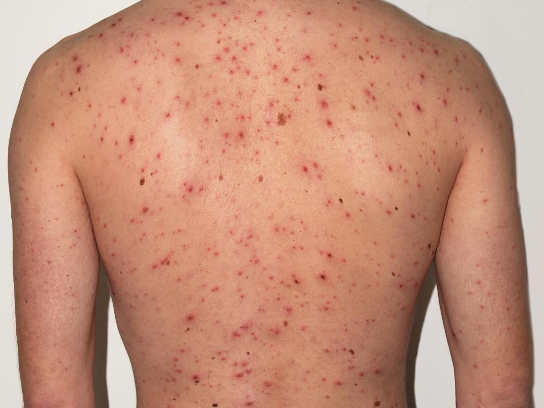 The Back Of A 30 Year Old Male Suffering From Chickenpox Image Credit F Malan 2010