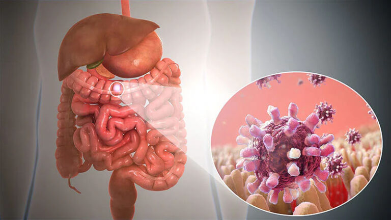 Gastroenteritis Demystified